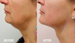 face before after (4) face before after (4)